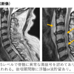 脊髄損傷のCT,MRI画像診断のポイント